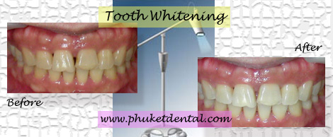 Tooth Whitening:Coldlight,non-LASER,LED,Natural Plus at Phuket Dental Clinic,Thailand